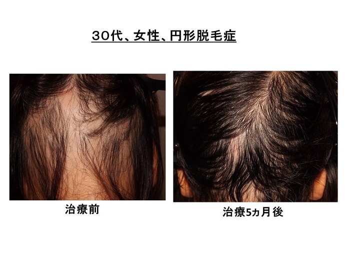 円形脱毛症　病院""